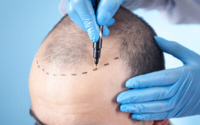 The Quiet Destigmatization of the Hair Transplant